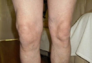 Εκδηλώσεις οστεοαρθρίτιδας της άρθρωσης του γόνατος (1)