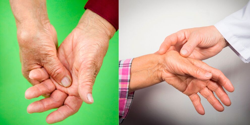 Οίδημα και πόνος στον πόνο είναι τα πρώτα σημάδια της οστεοαρθρίτιδας των χεριών