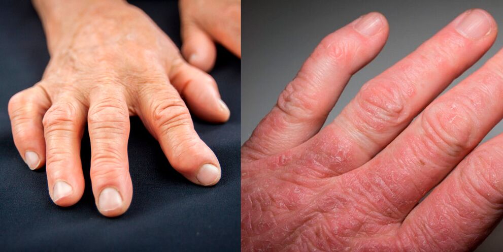 ρευματοειδής και ψωριασική αρθρίτιδα των χεριών