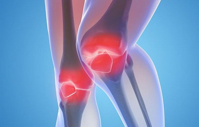 Οστεοαρθρίτιδα των αρθρώσεων του γόνατος