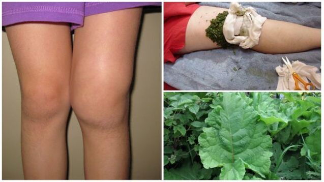 Φυτική κομπρέσα για οστεοαρθρίτιδα γόνατος